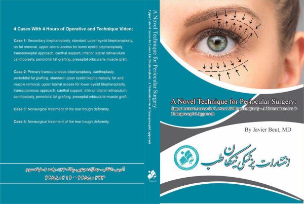 *(2025)*A Novel Technique for Periocular Surgery: Upper Lateral Access for *Lower Lid Blepharoplasty*- A Transcutaneous and Transpreseptal Approach. *Javier Beut, MD* *4 hours of operative and technique video!* ——————— *4 Cases With 4 Hours of Operative and Technique Video: Case 1: Secondary blepharoplasty, standard upper eyelid blepharoplasty, no fat removal, upper lateral access for lower eyelid blepharoplasty, transpreseptal approach, canthal support, inferior lateral retinaculum canthoplasty, periorbital fat grafting, preseptal orbicularis muscle graft. Case 2: Primary transcutaneous blepharoplasty, canthoplasty, periorbital fat grafting, standard upper eyelid blepharoplasty, fat and muscle removal, upper lateral access for lower eyelid blepharoplasty, transcutaneous approach, canthal support, inferior lateral retinaculum canthoplasty, periorbital fat grafting, preseptal orbicularis muscle graft. Case 3: Nonsurgical treatment of the tear trough deformity. Case 4: Nonsurgical treatment of the tear trough deformity. Summary *4*. ساعت فیلم جراحی 🎦 **تکنیک جدید برای جراحی پری‌اوکولار: دسترسی فوقانی جانبی برای بلفاروپلاستی پلک پایین—* ترانس‌کاتنئوس و ترانس‌پرسپتالی** آماده تحویل ۶۶۵۸۰۲۲۳ ۶۶۵۸۰۲۱۶ Nikan-teb.com